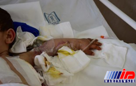 دست قطع شده کودک 3 ساله در تسمه تراکتور با موفقیت پیوند خورد+ تصاویر