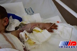 دست قطع شده کودک 3 ساله در تسمه تراکتور با موفقیت پیوند خورد+ تصاویر